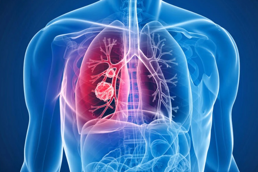 A tüdőrák az összes rákos megbetegedés 13%-át teszi ki. A következő tünetekre kell figyelni: tartós, három hétig vagy tovább tartó száraz vagy nyálkás köhögés, visszatérő mellkasi fertőzések, rekedtség vagy rekedt hang, légszomj, sípoló légzés vagy mellkasi fájdalom.