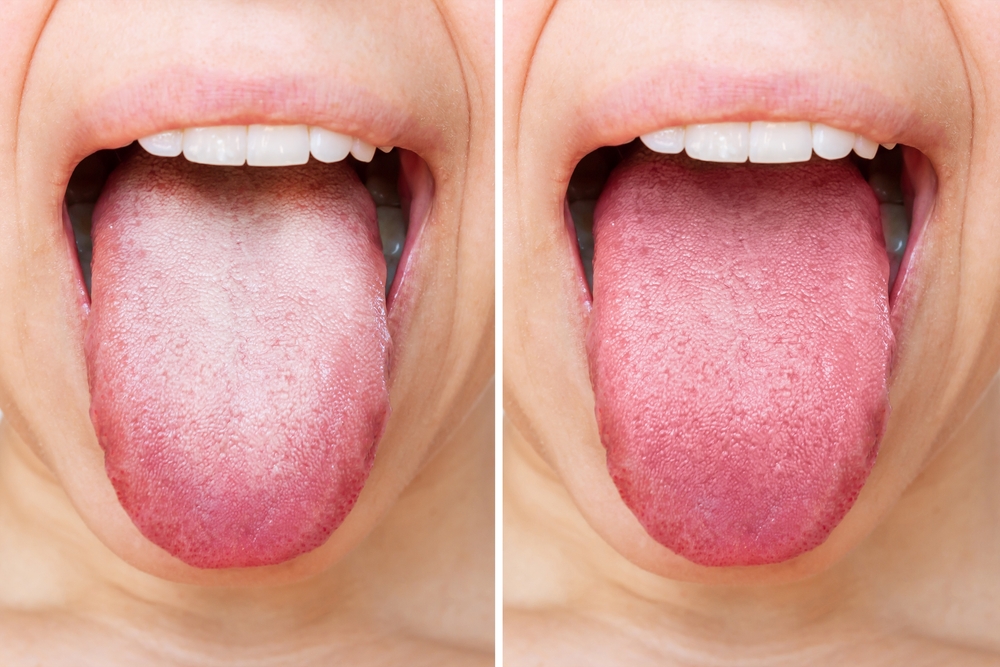 Míg a bőrünkre vagy a fogainkra minden nap figyelünk, a nyelvünkről megfeledkezünk. A nyelv azonban a test kapuja és az emésztőrendszer része.   A sötétvörös nyelv például azt jelenti, hogy a szervezet fertőzéssel küzd. Gyakran lázzal jelenik meg.