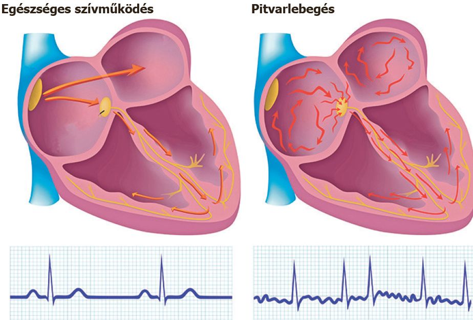 szív egészségi diagram