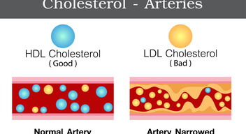 A felesleges LDL-koleszterin lerakódik az artériákban, azok pedig fokozatosan elmeszesednek. Keresztmetszetük beszűkül, ami rontja a szövetek vérellátását. Azok a szervek, amelyeknek sok tápanyagra és oxigénre van szükségük, szenvednek, és károsodhatnak.