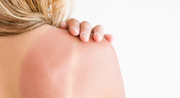 A bőr túlzott UVB-sugárzásnak való kitettsége és a hirtelen, égéssel járó napsugárzás a bőrrák egyik legnagyobb kockázati tényezője. „Amikor behatol a bőr felső rétegeibe, károsítja a sejtek DNS-ét, növeli a szabad gyökök képződését és a bőrdaganatok valószínűségét“ – magyarázta Žigová.