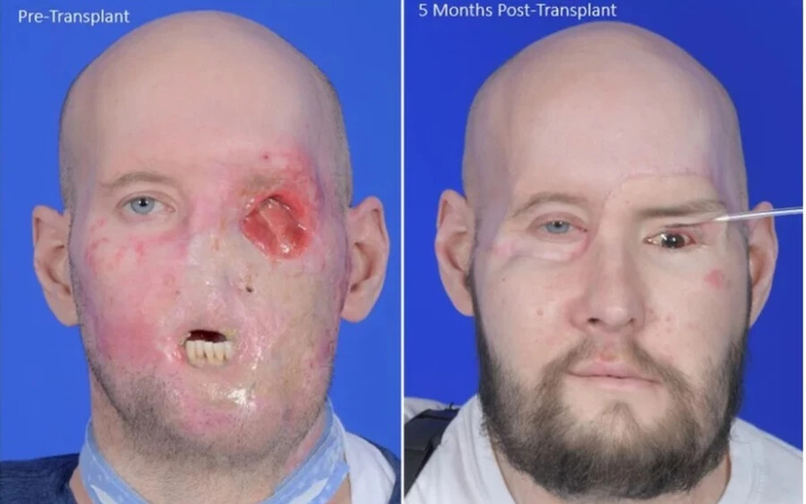 A beteg Aaron James villanyszerelő volt, akit 2021 júniusában egy villanyvezeték-ellenőrzés során 7,2 kilovoltos szikrakisülés talált arcon, melynek következtében súlyos sérüléseket szenvedett a fején, a nyakán és a bal karján, bal szemére pedig megvakult.