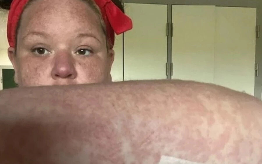 Egy 37 éves brit nő a Dominikai Köztársaságban nyaralt, mikor megcsípte egy ázsiai tigrisszúnyog. Ezt követően a testén hatalmas kiütések jelentek meg, amire orvosa automatikusan erős antibiotikumokat írt fel. 
