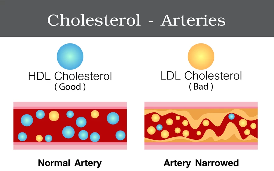 A felesleges LDL-koleszterin lerakódik az artériákban, azok pedig fokozatosan elmeszesednek. Keresztmetszetük beszűkül, ami rontja a szövetek vérellátását. Azok a szervek, amelyeknek sok tápanyagra és oxigénre van szükségük, szenvednek, és károsodhatnak.