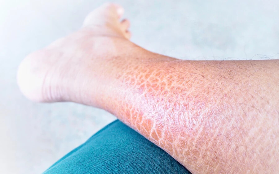 A bőrszárazságra való hajlamosságban a genetika is közrejátszhat: az ichthyosis vulgaris egy genetikai eredetű bőrbetegség, amely a bőr állandó viszketése miatt akár véres sebeket is okozhat.