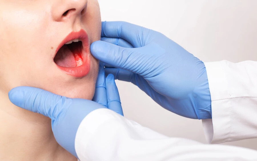 További tünetek lehetnek a néhány héten belül nem gyógyuló szájfekélyek, fehér vagy vörös foltok a száj és a nyelv nyálkahártyáján, a beszéd megváltozása, tartós csomók a szájban vagy a torokban, a foghúzás után nem gyógyuló sebek, vagy zsibbadásérzés az ajkakon vagy a nyelven.