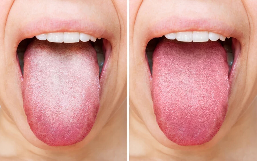 Míg a bőrünkre vagy a fogainkra minden nap figyelünk, a nyelvünkről megfeledkezünk. A nyelv azonban a test kapuja és az emésztőrendszer része.   A sötétvörös nyelv például azt jelenti, hogy a szervezet fertőzéssel küzd. Gyakran lázzal jelenik meg.