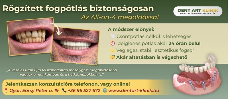 dent dent