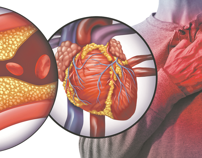 trigliceridek és a szív egészsége