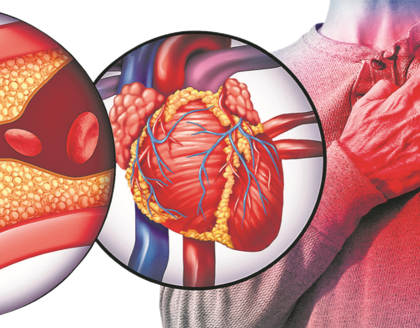 Miokardiális infarktus - Szívroham utáni élet (2) - Egészségügyi lapok és orvosi tanácsok