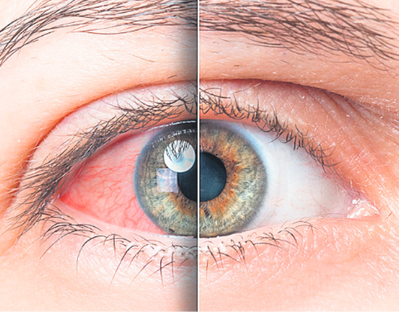 a szem magas vérnyomásának tünetei