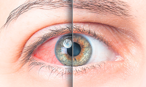 a szem hipertóniáját kezelik LV magas vérnyomás